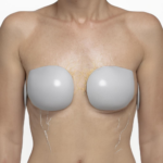 Iontophorese gegen Hyperhidrose: Evidenz, Wirkmechanismen und praktische Tipps für Sie