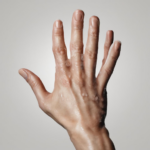 Schweißhände behandeln: Wie Sie evidenzbasiert und praxisnah vorgehen