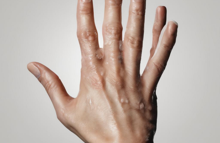 Schweißhände behandeln: Wie Sie evidenzbasiert und praxisnah vorgehen 19 Schweißhände behandeln: Wie Sie evidenzbasiert und praxisnah vorgehen