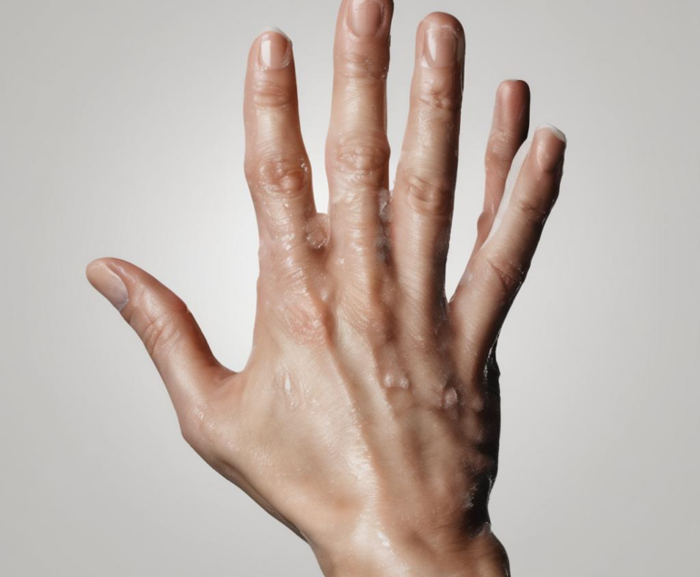 Schweißhände behandeln: Wie Sie evidenzbasiert und praxisnah vorgehen